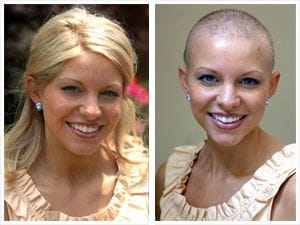 Learning to Cope With Cancer-related Hair Loss